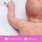 Mengurangi Alergi pada Kulit Bayi dengan Krim Bayi Anti Alergi